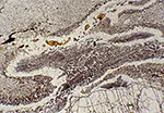 Kyanitförande eklogit under mikroskopet: här syns ”frusna” mineralreaktioner som skedde under upplyftning och tryckavlastning.